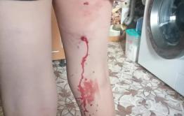 Собака напала на 10-летнего мальчика и прокусила ему ногу на «Зенитке» в Чите