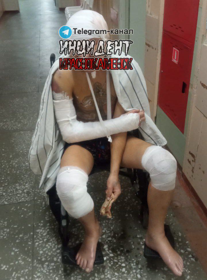 Переломы рук и ног – в Краснокаменске избит боец ЧВК «Вагнер»